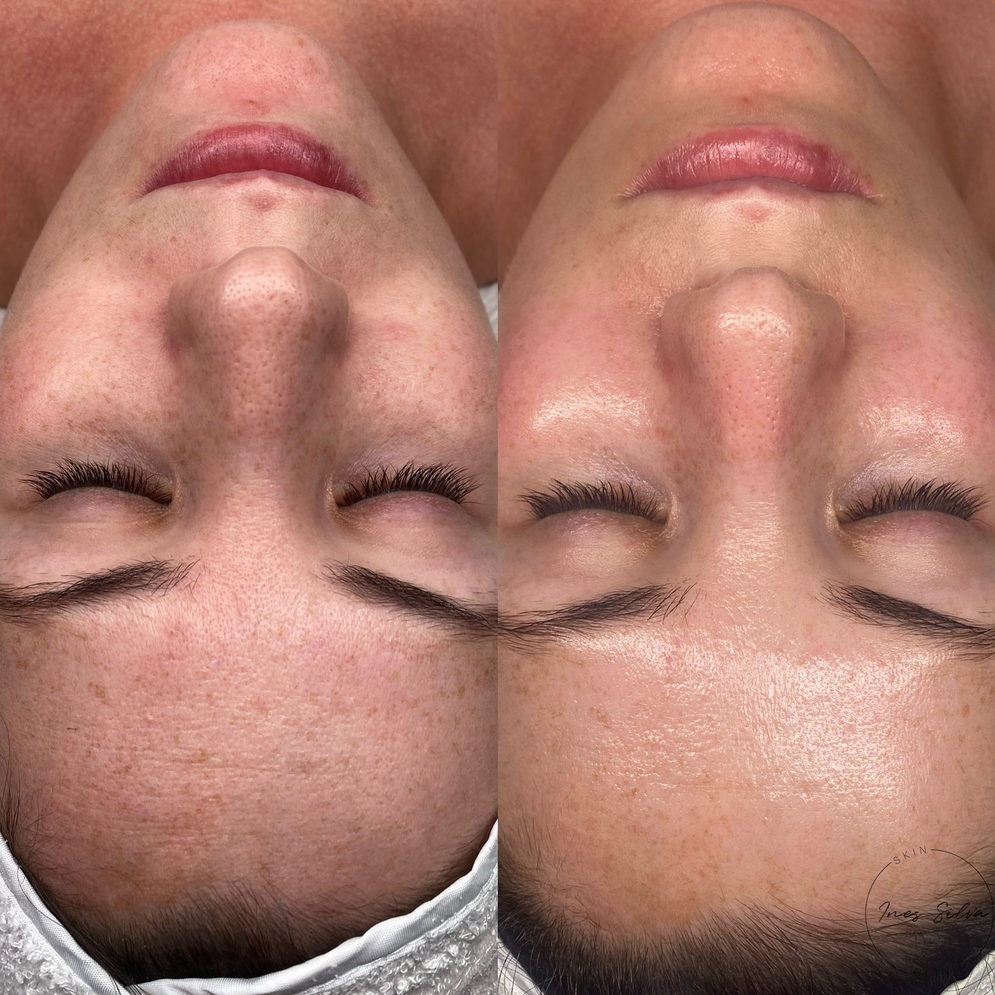 SkinBetter peel